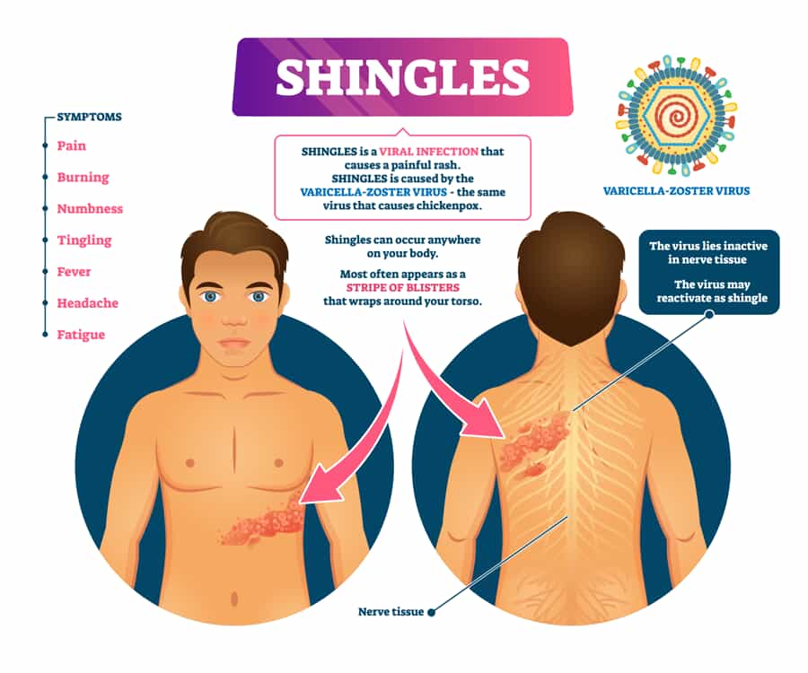shingles early symptoms